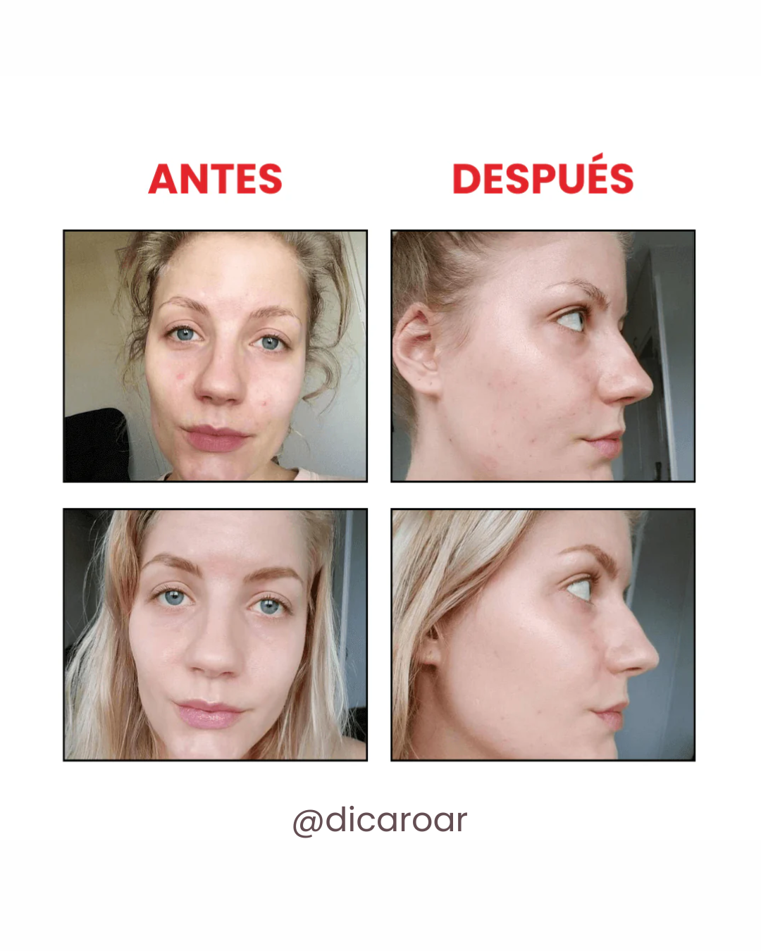 The Ordinary Niacinamida 10% + Zinc 1% - Niacinamide 10% + Zinc 1%